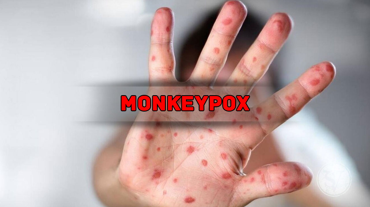 monkey pox a pandemic like Covid 19